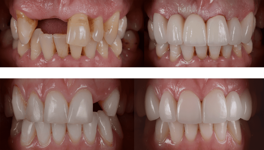 Fill in tooth gaps